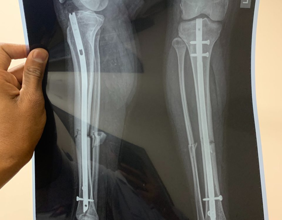 Indemnisation d’une erreur médicale